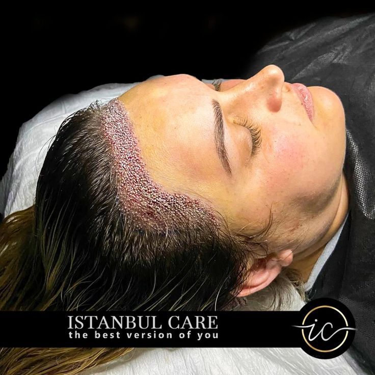 Frauen Haartransplantation