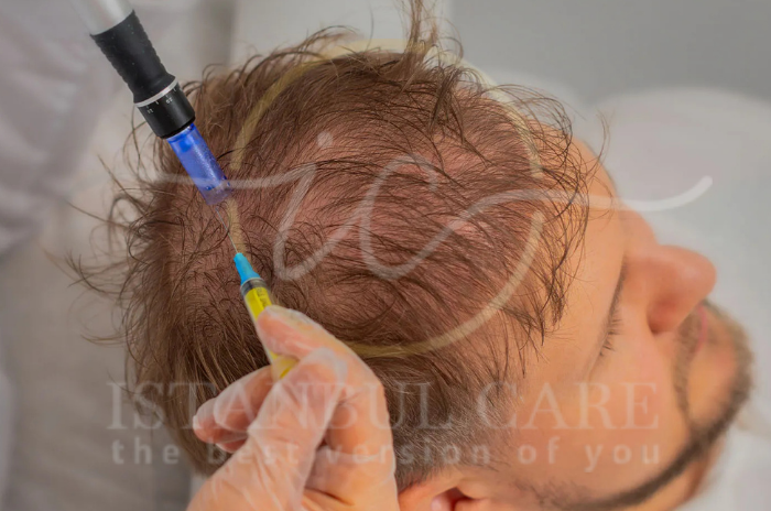 Benefits of Peptide Therapy for Hair Growth