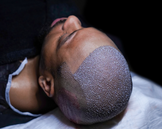 Transplanti i flokëve FUE