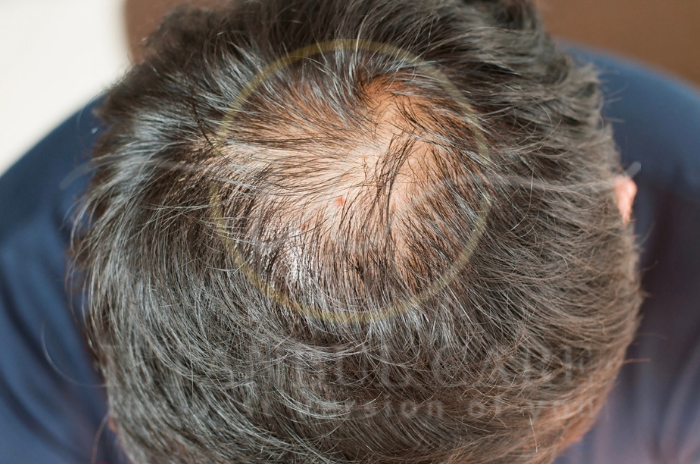 How Much Hair Shedding Is Normal Daily Hair Loss Explained