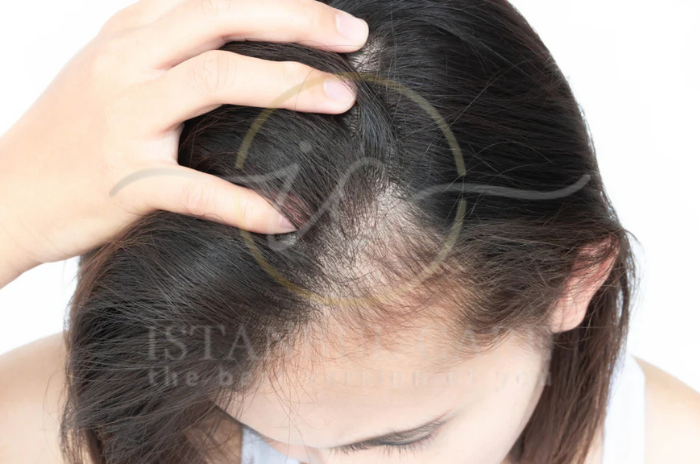 Can Stress Cause Hair Loss Treatment