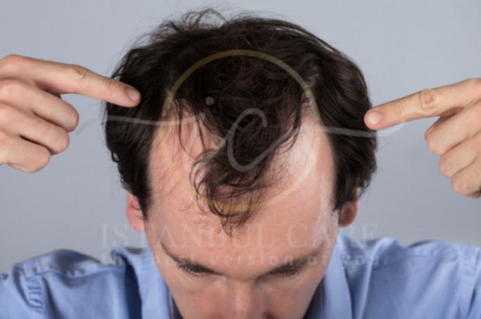 Can Stress Cause Hair Loss